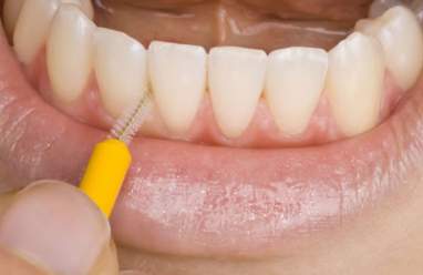 ¿Por qué es tan importante la limpieza interdental?