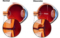 La mala salud bucal puede estar asociada con el glaucoma